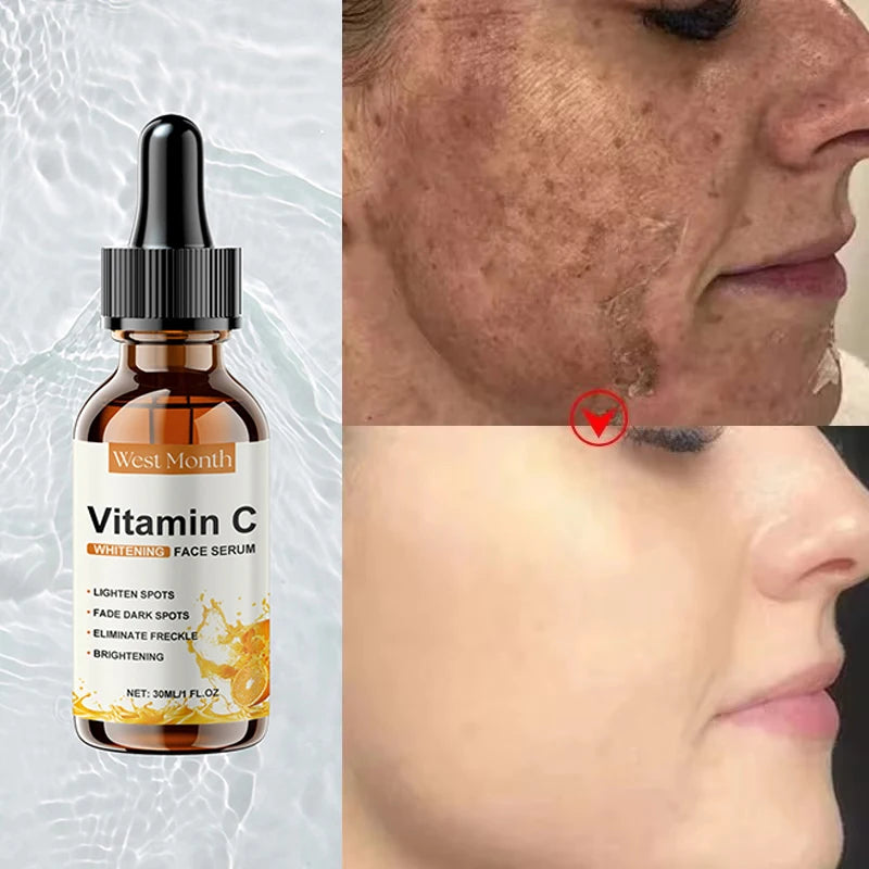 Vitamin C Whitening Serum Remove Freckles Dark Spots Face Essence Fade Melasma Melanin Brighten Repair Dull Skin Care Cosmetics