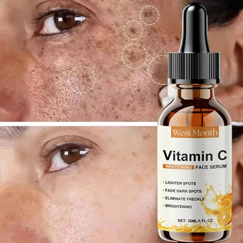 Vitamin C Whitening Serum Remove Freckles Dark Spots Face Essence Fade Melasma Melanin Brighten Repair Dull Skin Care Cosmetics